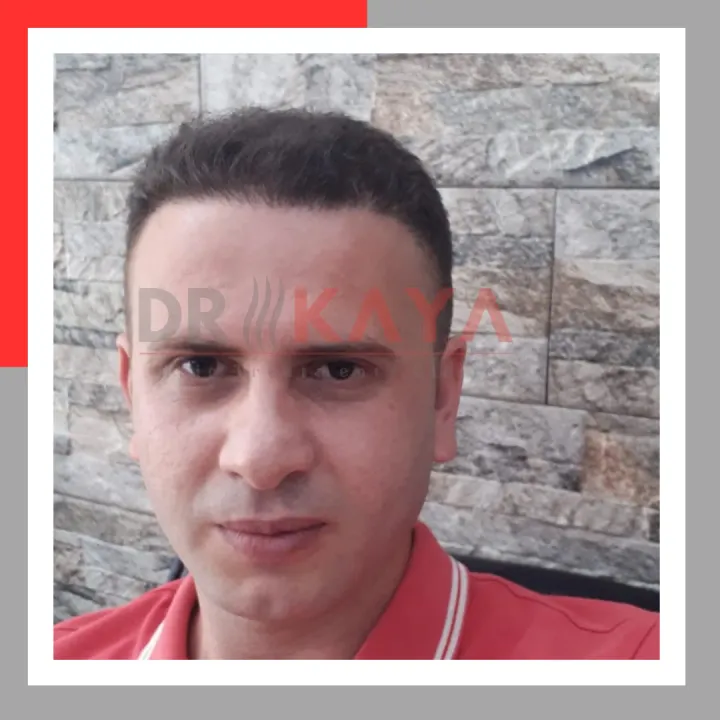 Sapphire FUE patient result at DRKAYA Clinic