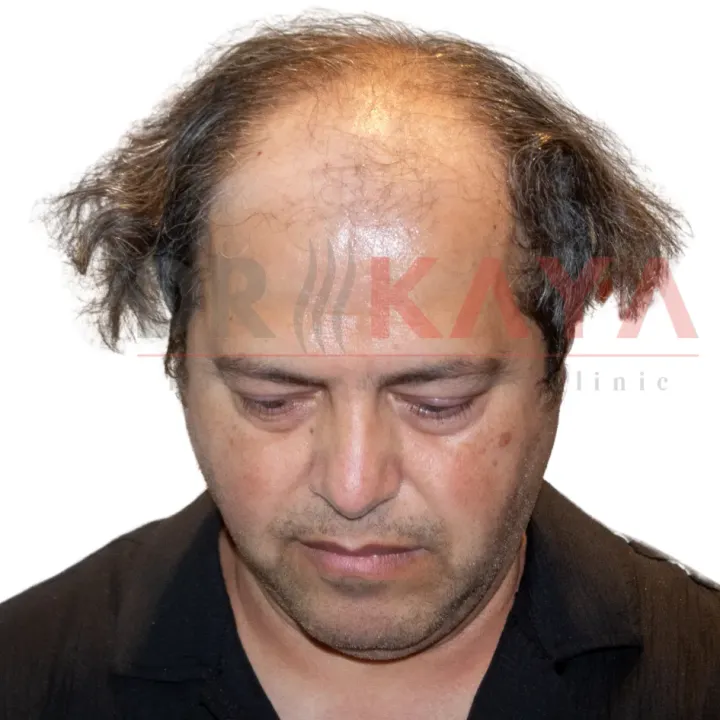 DHI patient before hair transplant at DRKAYA Clinic