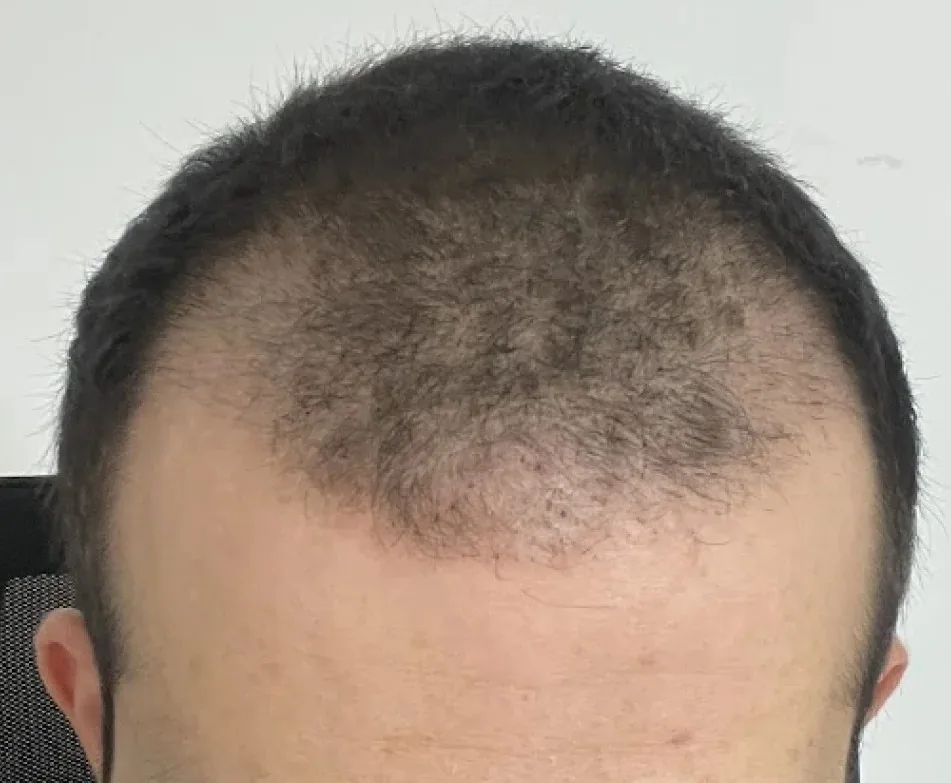 Hair density six months after transplant