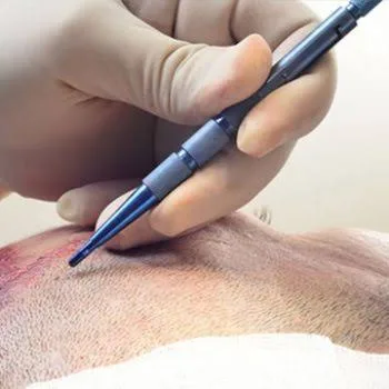 Sapphire FUE hair transplant technique with minimal scarring